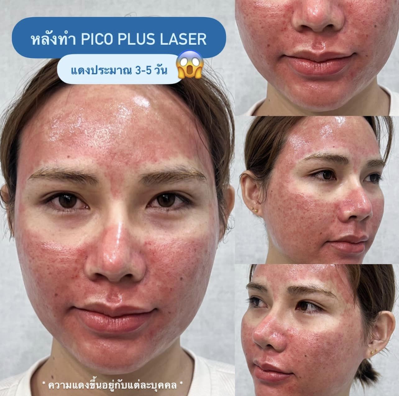 อย่าเพิ่งทำ Pico Plus Laser ถ้ายังไม่ได้อ่าน!! Articles SLC Clinic